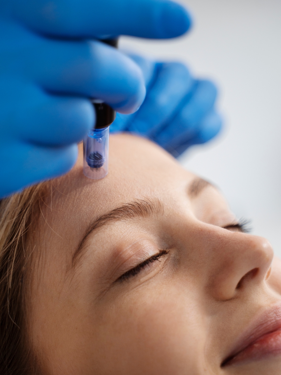 Microneedling