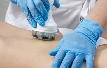 Microneedling