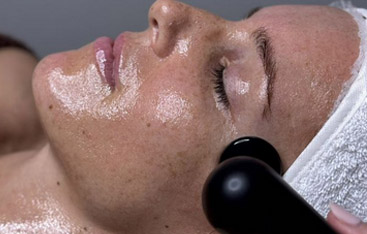 Microneedling