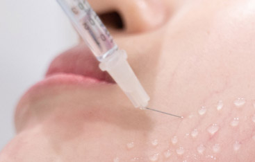 Microneedling