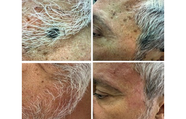 Microneedling