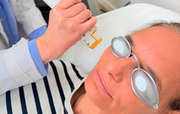 Microneedling