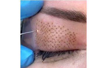 Microneedling