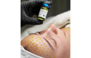 Microneedling