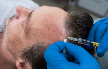 Microneedling