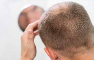 Microneedling