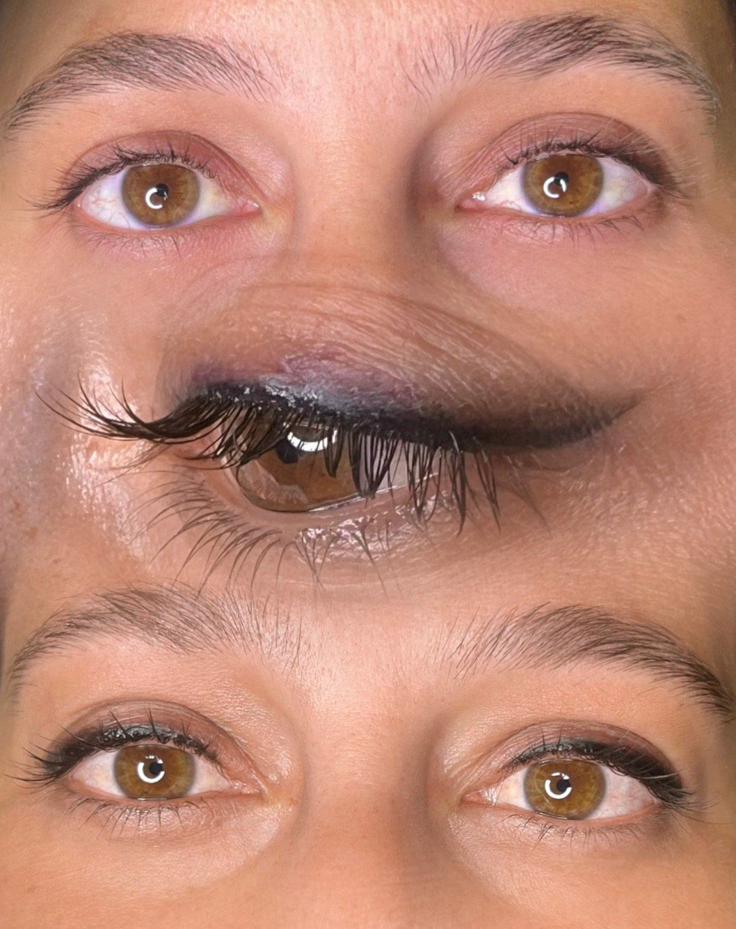 Microneedling